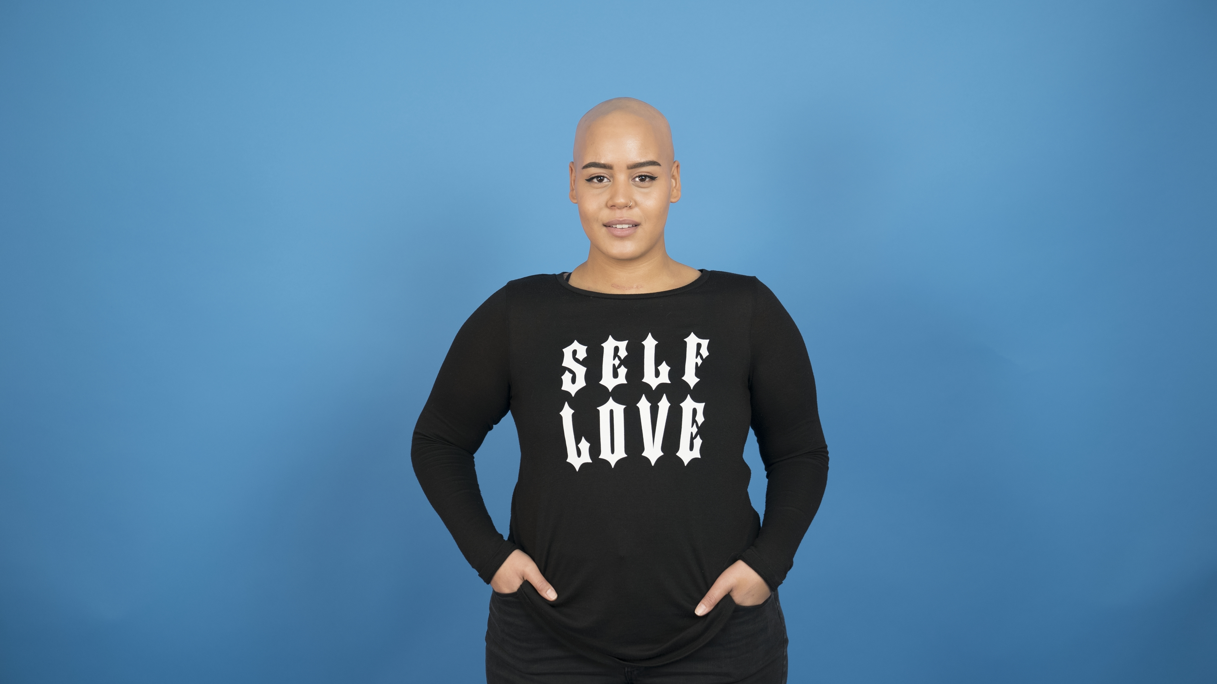 leva med alopecia